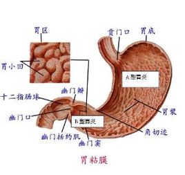 胃炎該如何確診